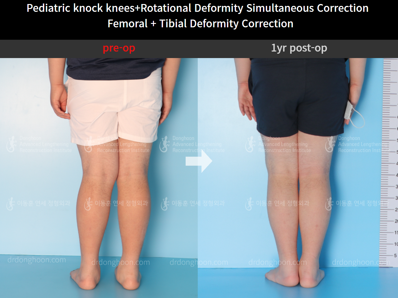 Before and after paediatric & adolescent knock knees, case 4640495, image 4, Dr. Donghoon institute (DALRI)