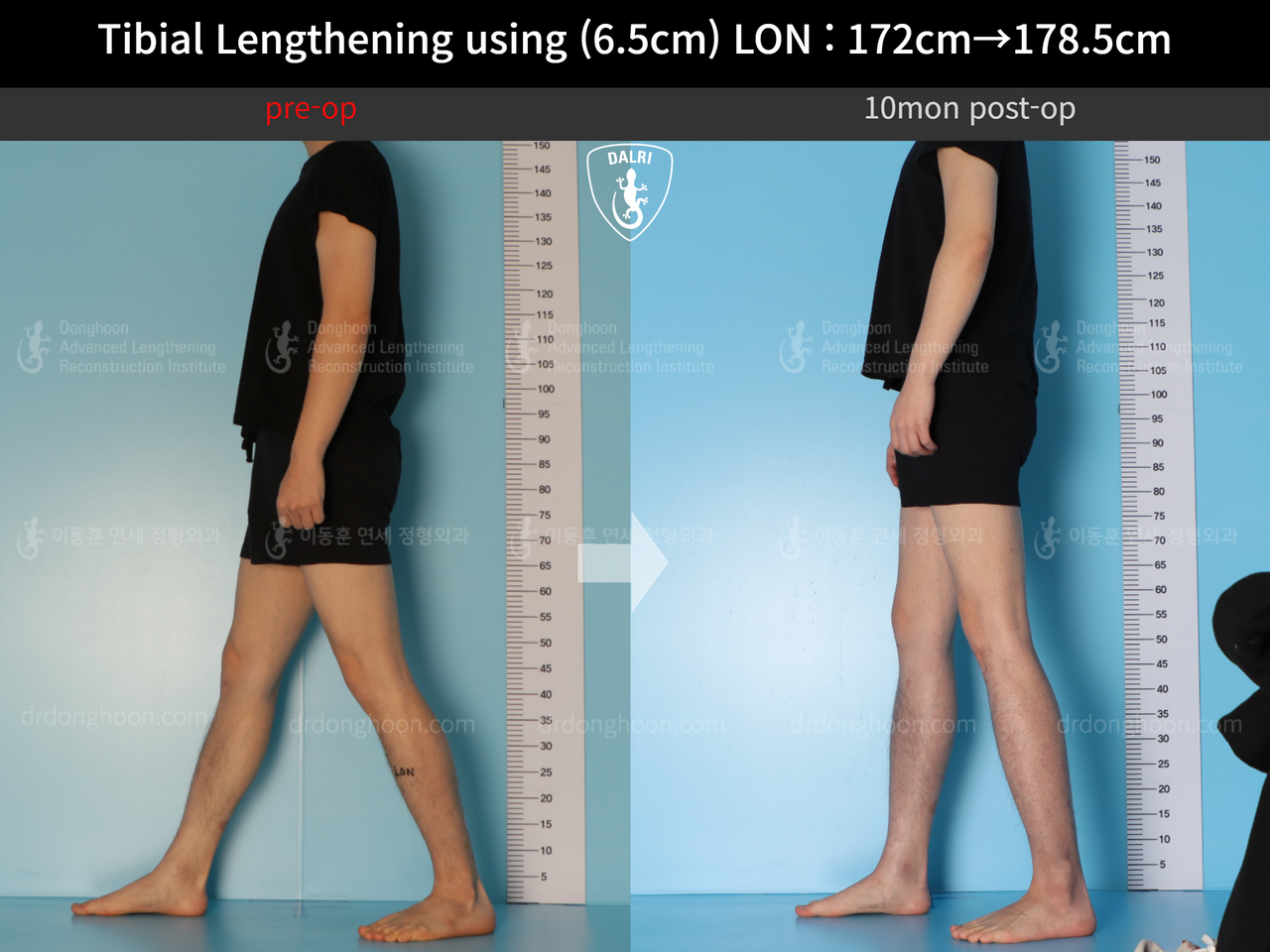 Before and after cll lon, case 13642628, image 3, Dr. Donghoon institute (DALRI)