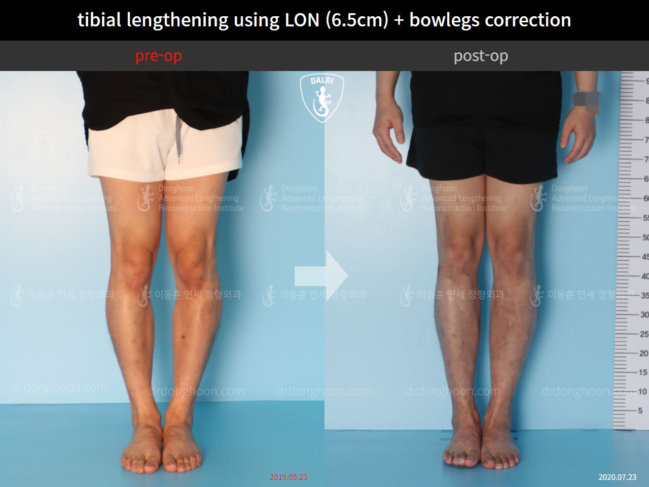 Before and after cll + deformity correction, case 4585639, image 5, Dr. Donghoon institute (DALRI)
