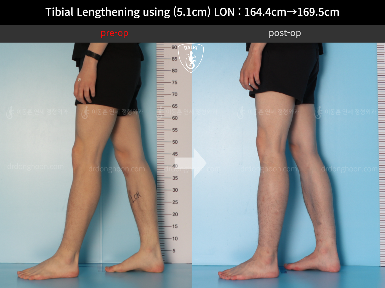 Before and after cll lon, case 12653375, image 8, Dr. Donghoon institute (DALRI)