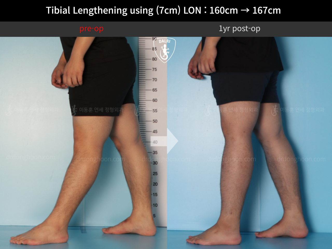 Before and after cll lon, case 12395704, image 8, Dr. Donghoon institute (DALRI)