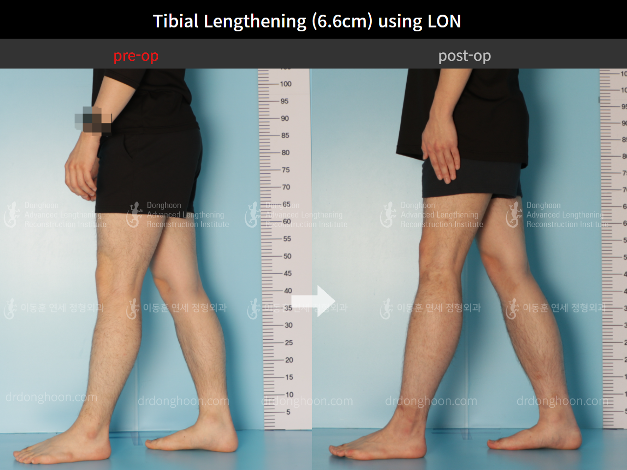 Before and after cll lon, case 8764128, image 8, Dr. Donghoon institute (DALRI)