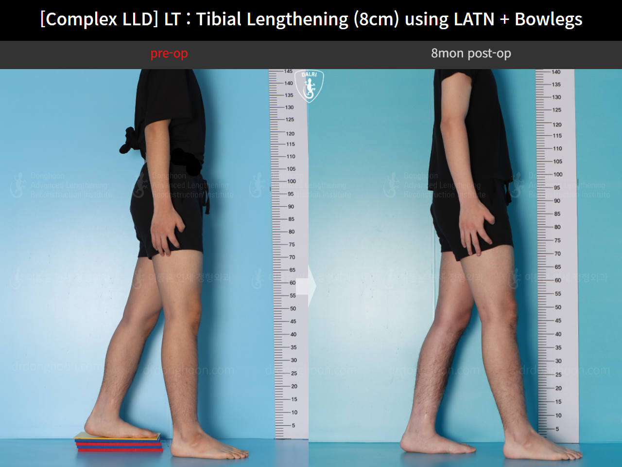 Before and after complex deformity, case 16724288, image 3, Dr. Donghoon institute (DALRI)