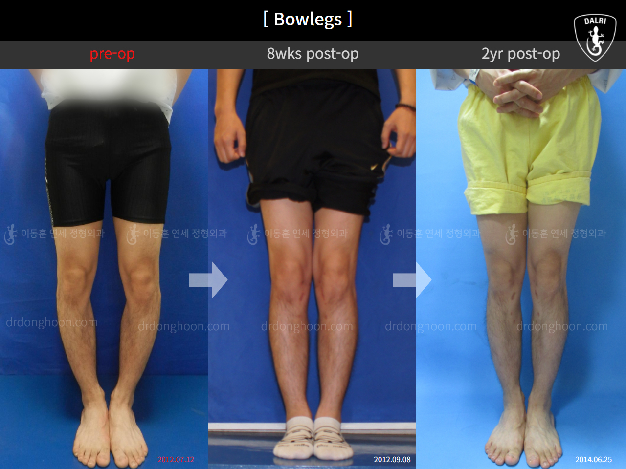 Before and after adult bowlegs, case 4311104, image 1, Dr. Donghoon institute (DALRI)