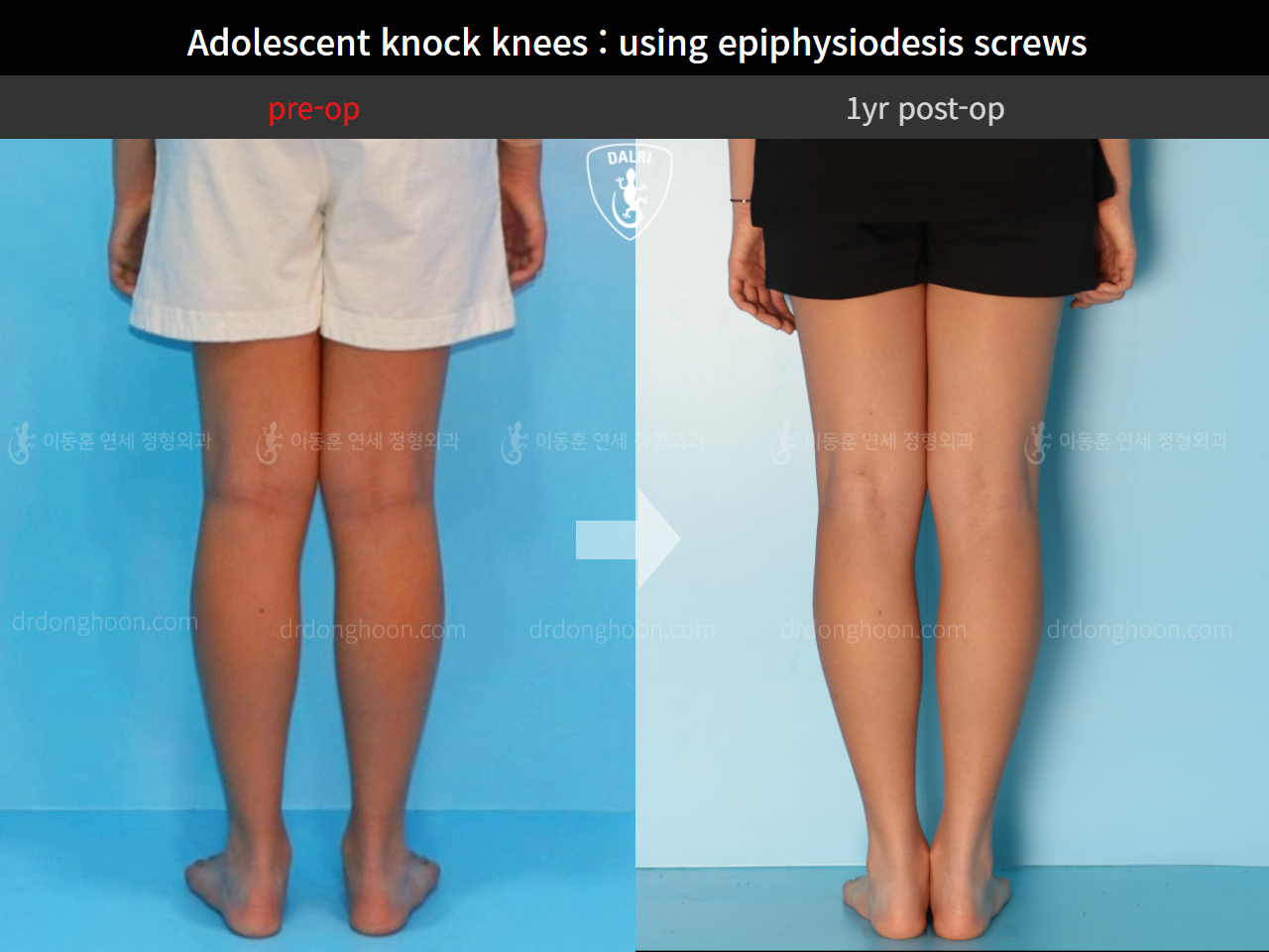 Before and after paediatric & adolescent knock knees, case 4310931, image 4, Dr. Donghoon institute (DALRI)
