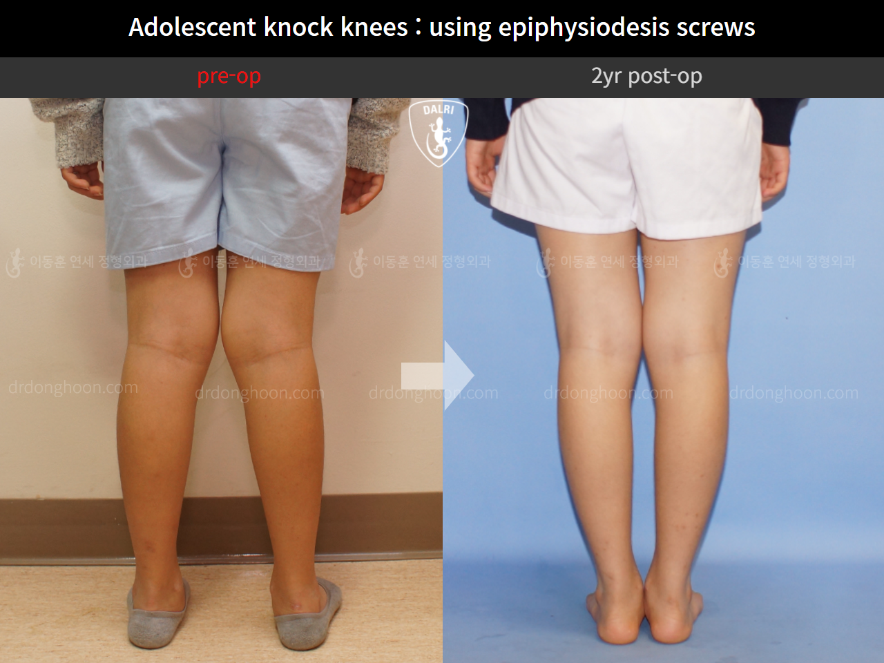 Before and after paediatric & adolescent knock knees, case 4640518, image 6, Dr. Donghoon institute (DALRI)