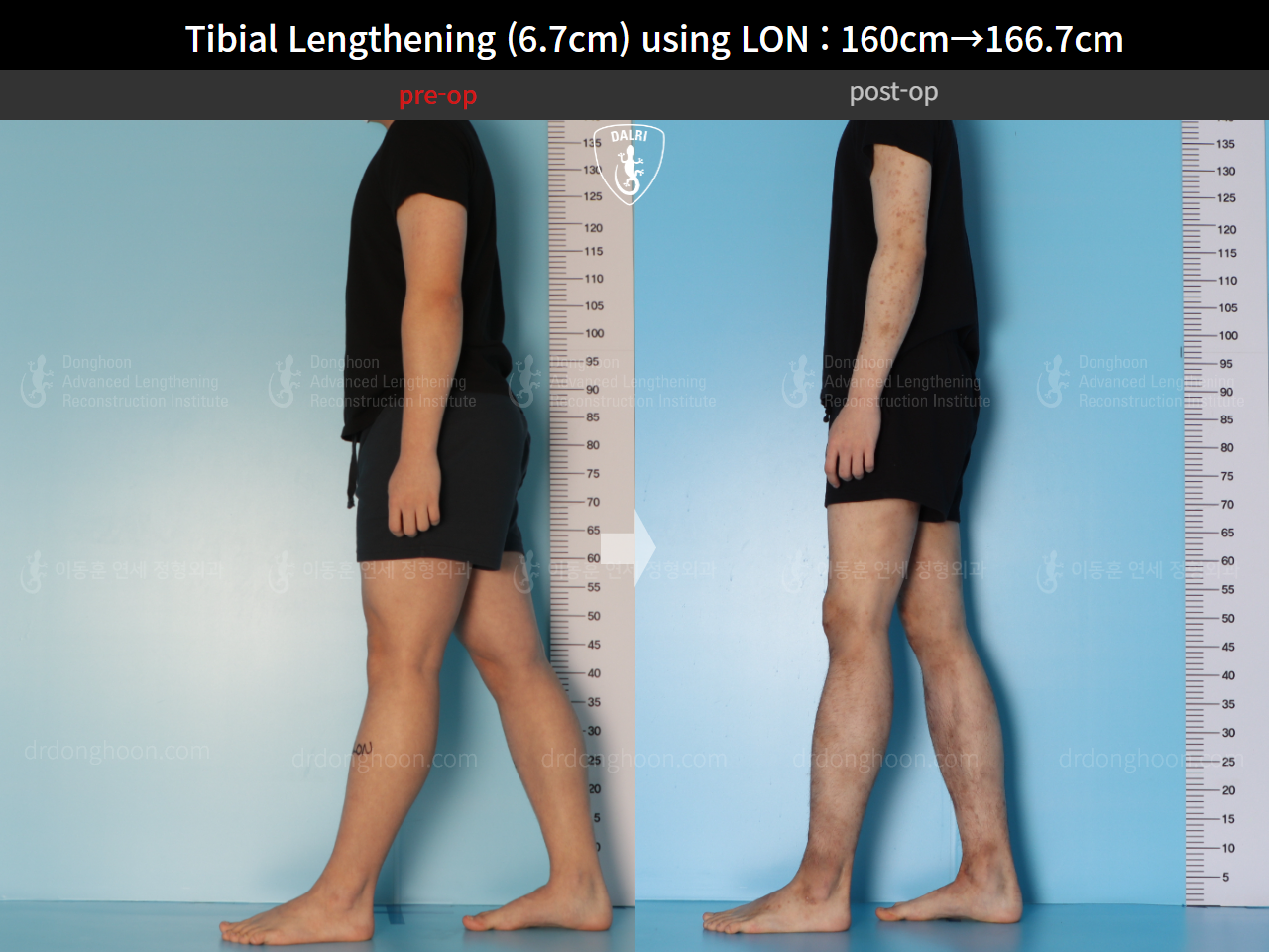 Before and after cll lon, case 15544530, image 3, Dr. Donghoon institute (DALRI)