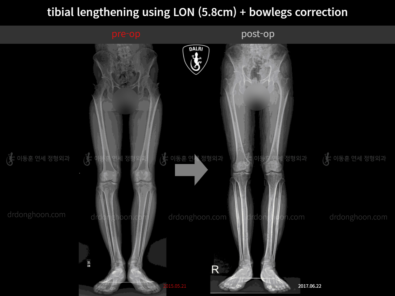Before and after cll lon, case 11363587, image 2, Dr. Donghoon institute (DALRI)