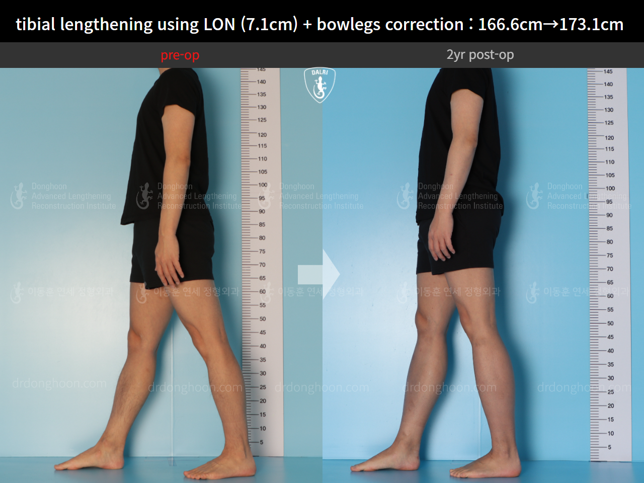Before and after cll lon, case 14678740, image 6, Dr. Donghoon institute (DALRI)