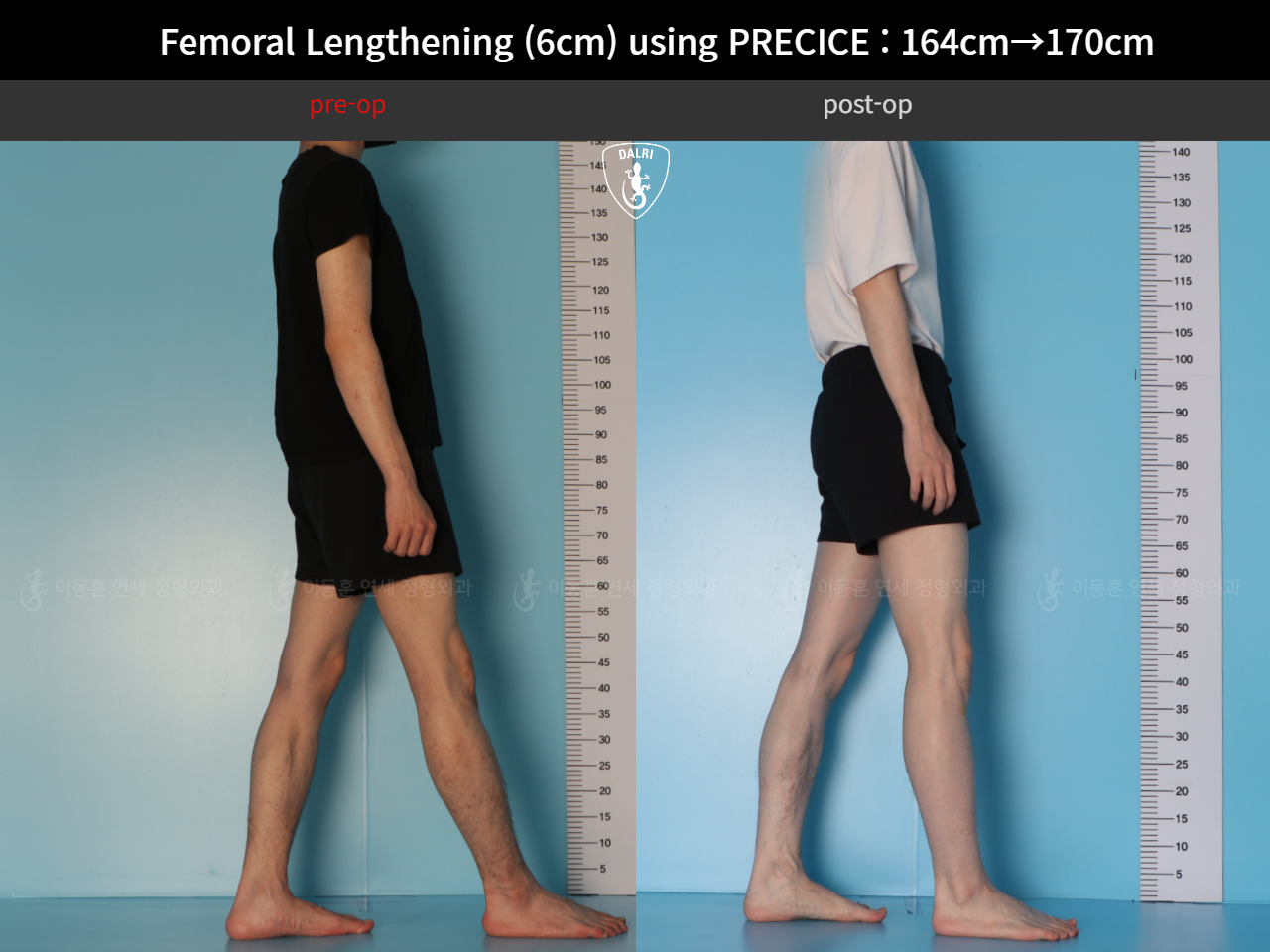 Before and after cll precice, case 33570290, image 3, Dr. Donghoon institute (DALRI)