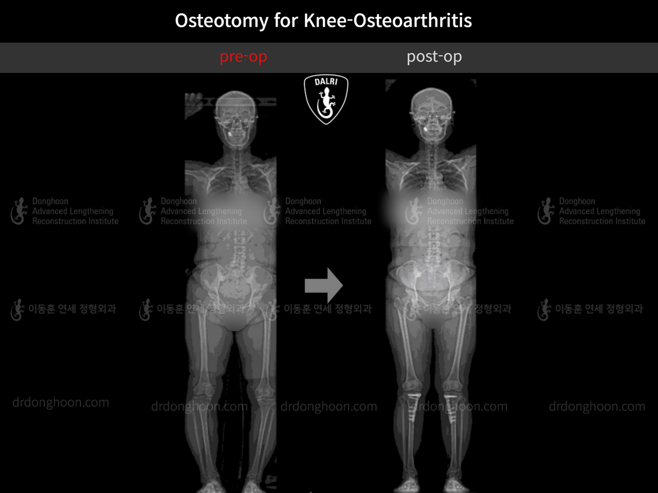 Before and after osteotomy for knee osteoarthritis, case 12992156, image 1, Dr. Donghoon institute (DALRI)