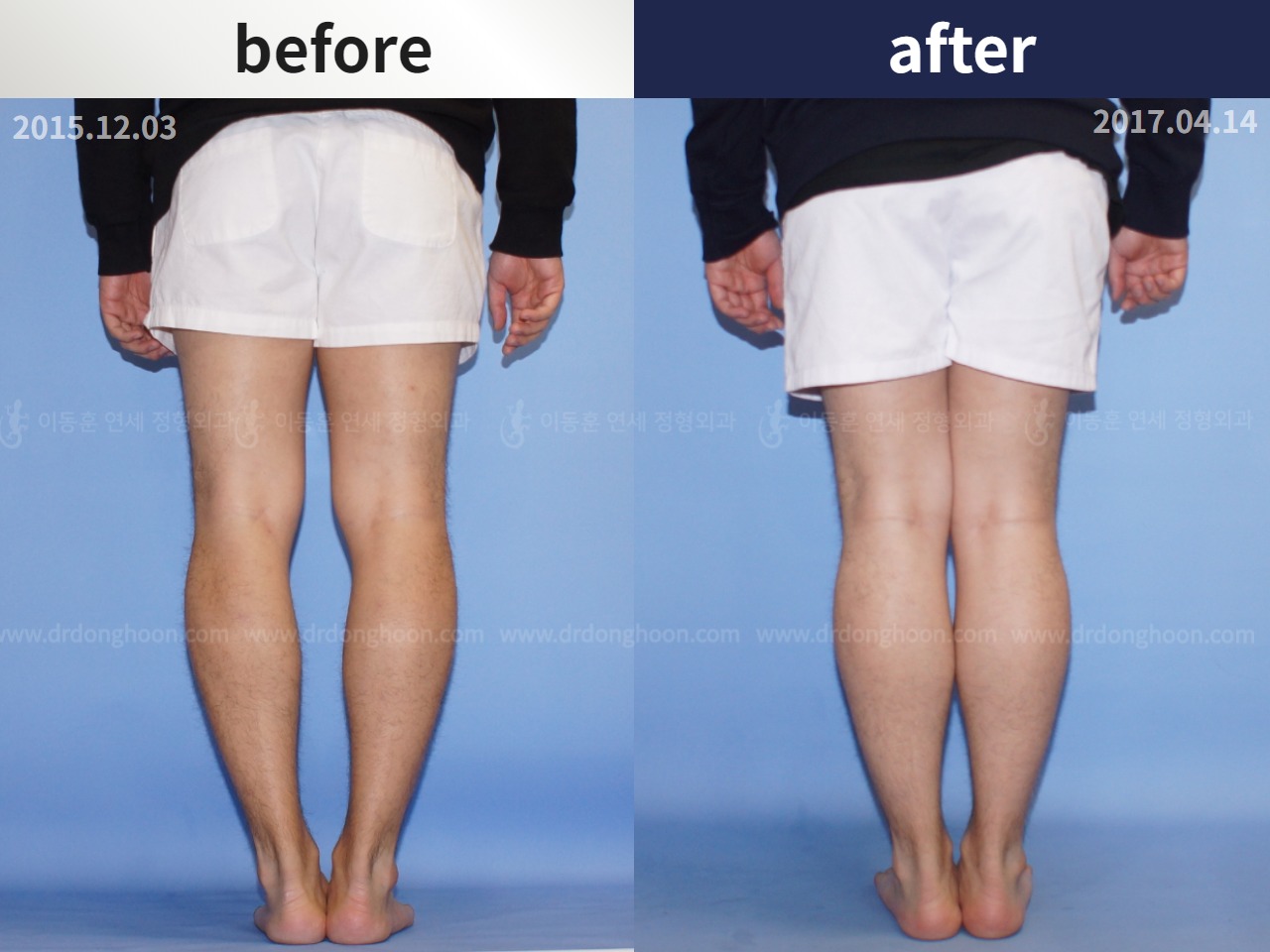 Before and after adult bowlegs, case 4311051, image 2, Dr. Donghoon institute (DALRI)