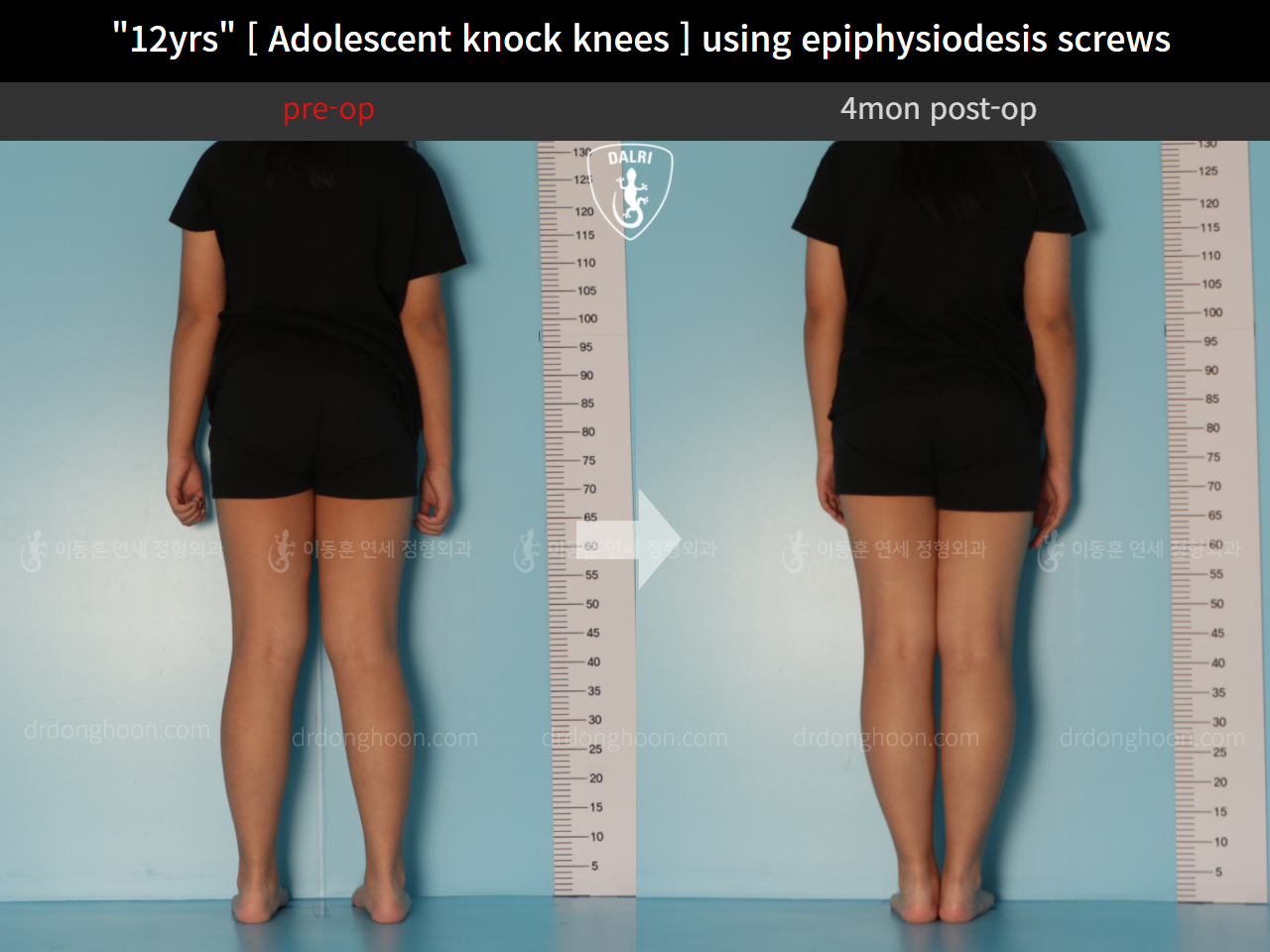 Before and after paediatric & adolescent knock knees, case 11772917, image 2, Dr. Donghoon institute (DALRI)