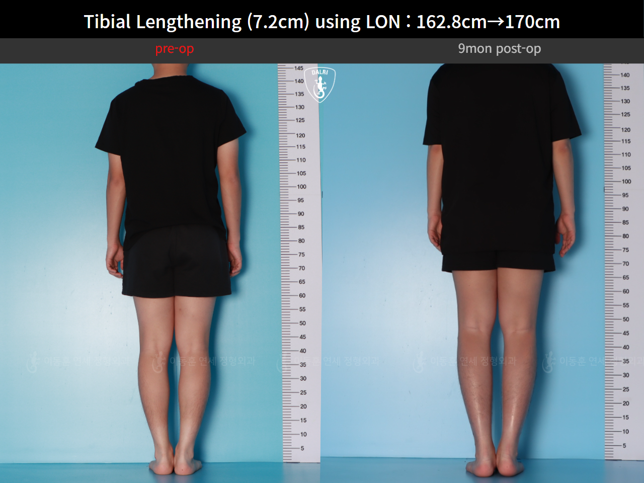 Before and after cll lon, case 124820559, image 3, Dr. Donghoon institute (DALRI)
