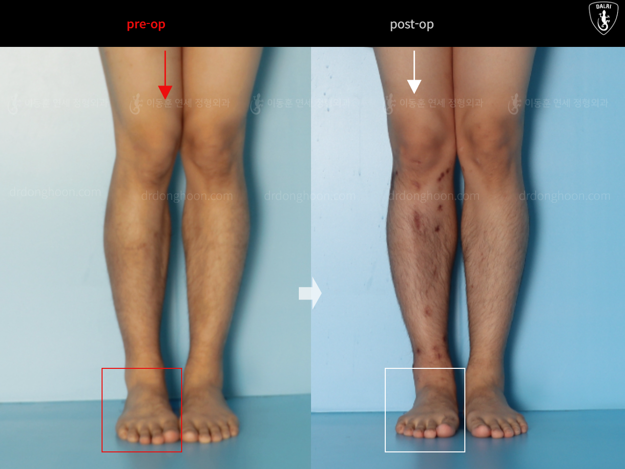 Before and after adult bowlegs, case 16482195, image 4, Dr. Donghoon institute (DALRI)