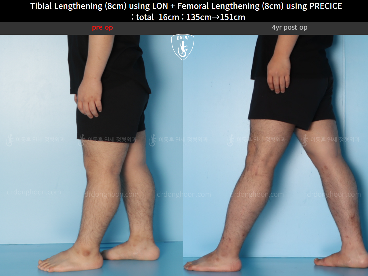 Before and after cll precice, case 128435842, image 8, Dr. Donghoon institute (DALRI)