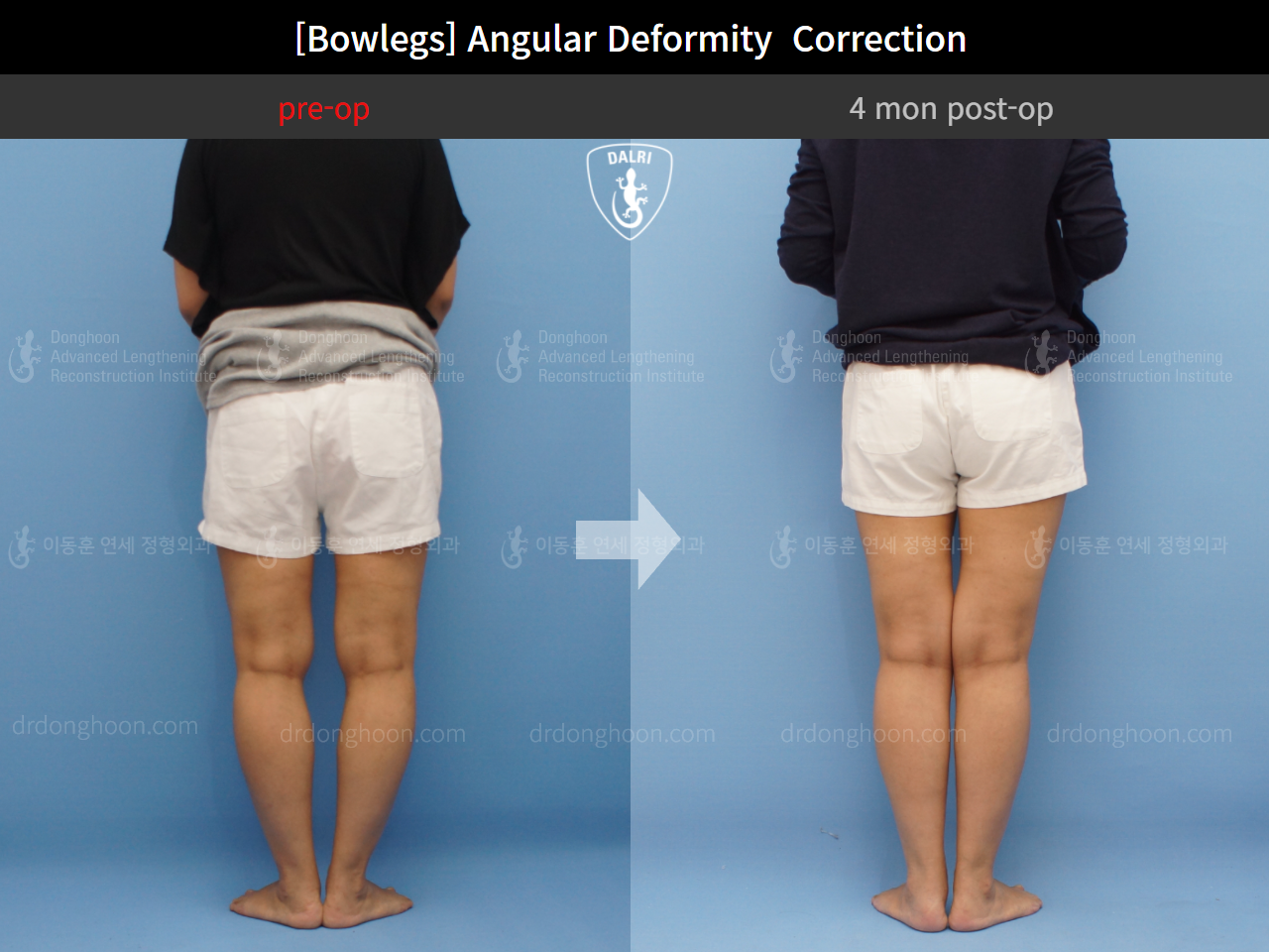 Before and after adult bowlegs, case 9289009, image 4, Dr. Donghoon institute (DALRI)
