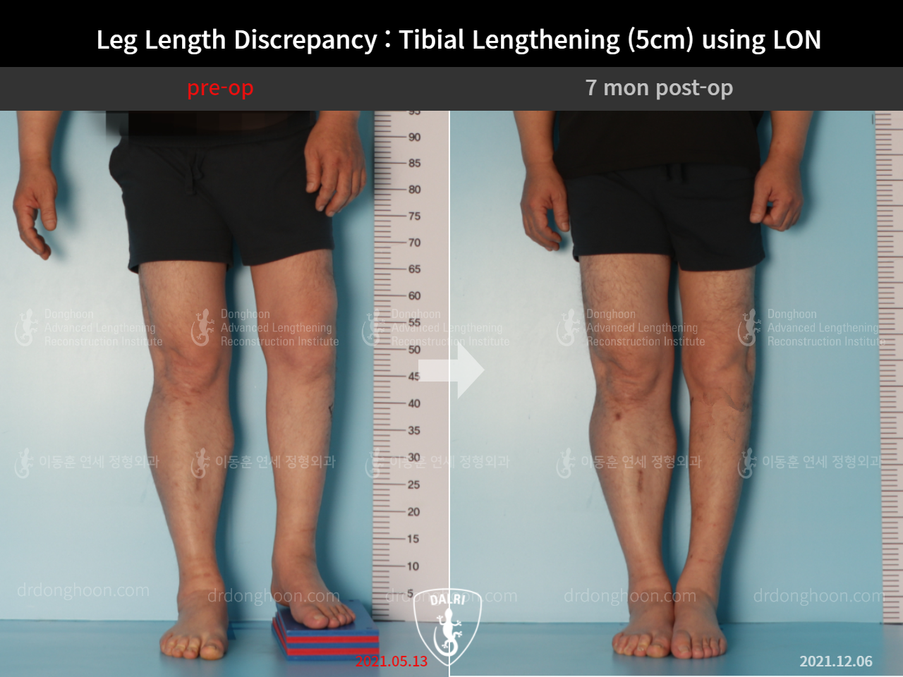 Before and after adult lld, case 9165807, image 5, Dr. Donghoon institute (DALRI)