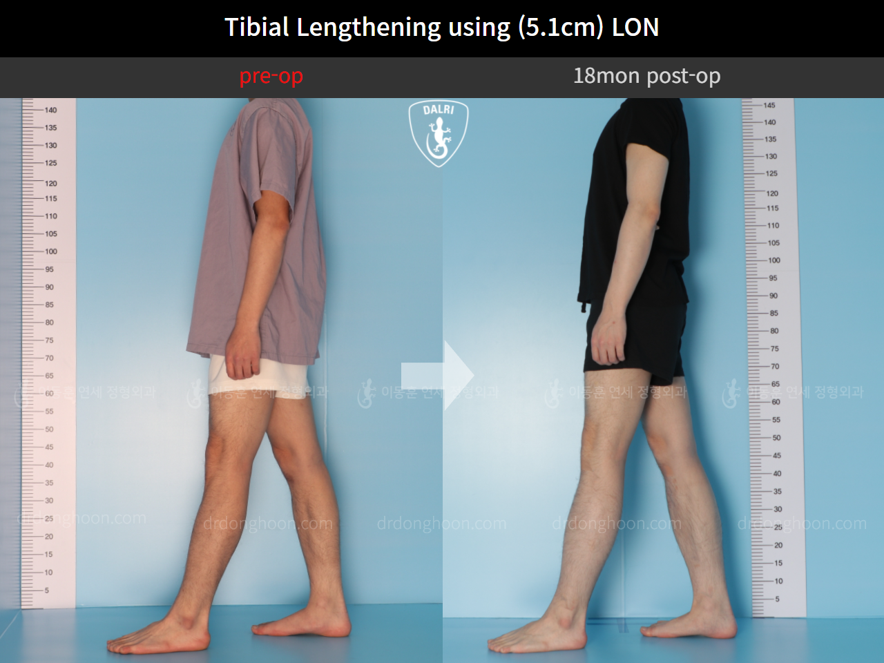 Before and after cll lon, case 9657314, image 3, Dr. Donghoon institute (DALRI)