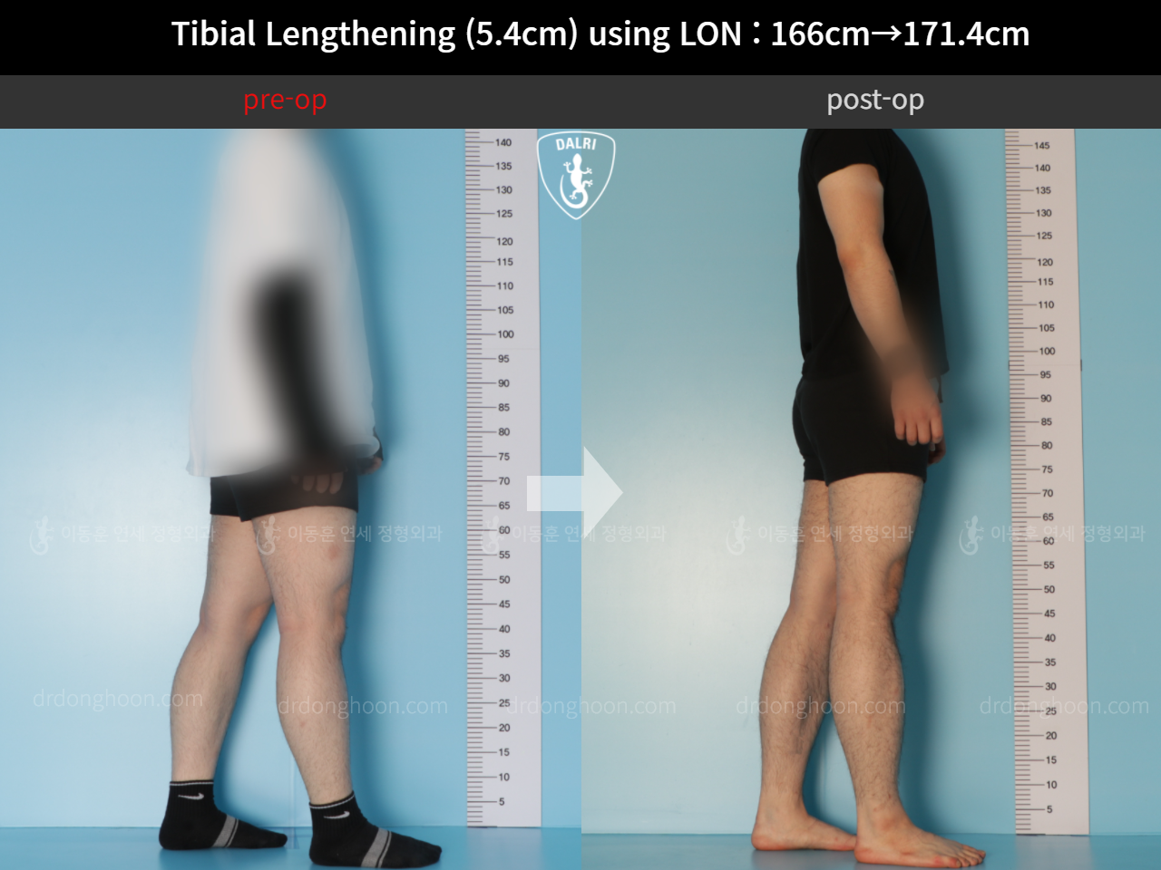 Before and after cll lon, case 11831572, image 4, Dr. Donghoon institute (DALRI)