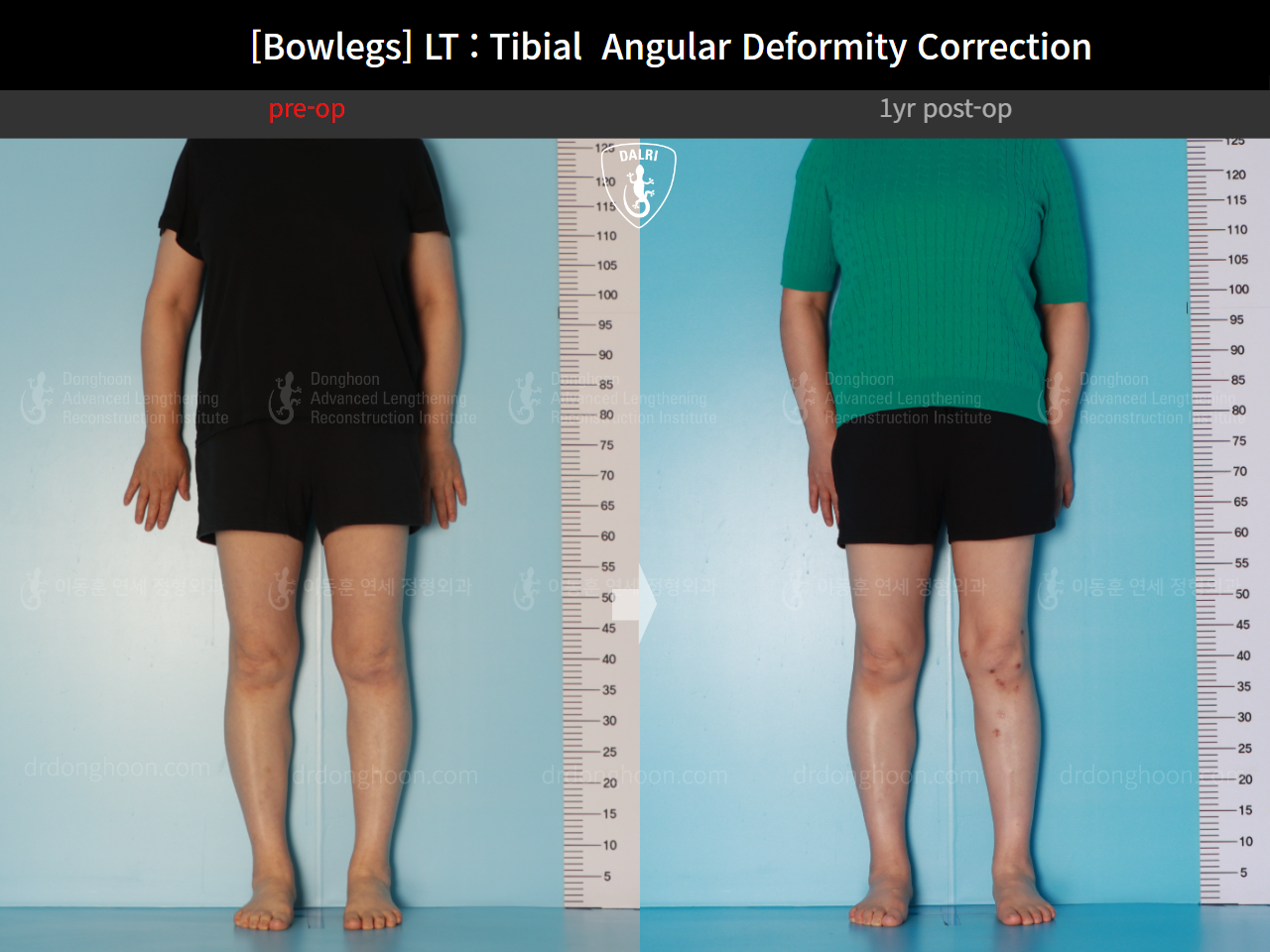 Before and after adult bowlegs, case 16787003, image 3, Dr. Donghoon institute (DALRI)