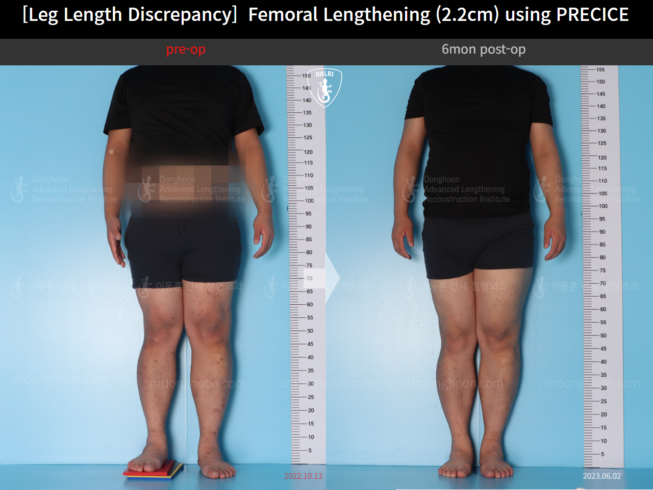Before and after adult lld, case 15416698, image 3, Dr. Donghoon institute (DALRI)