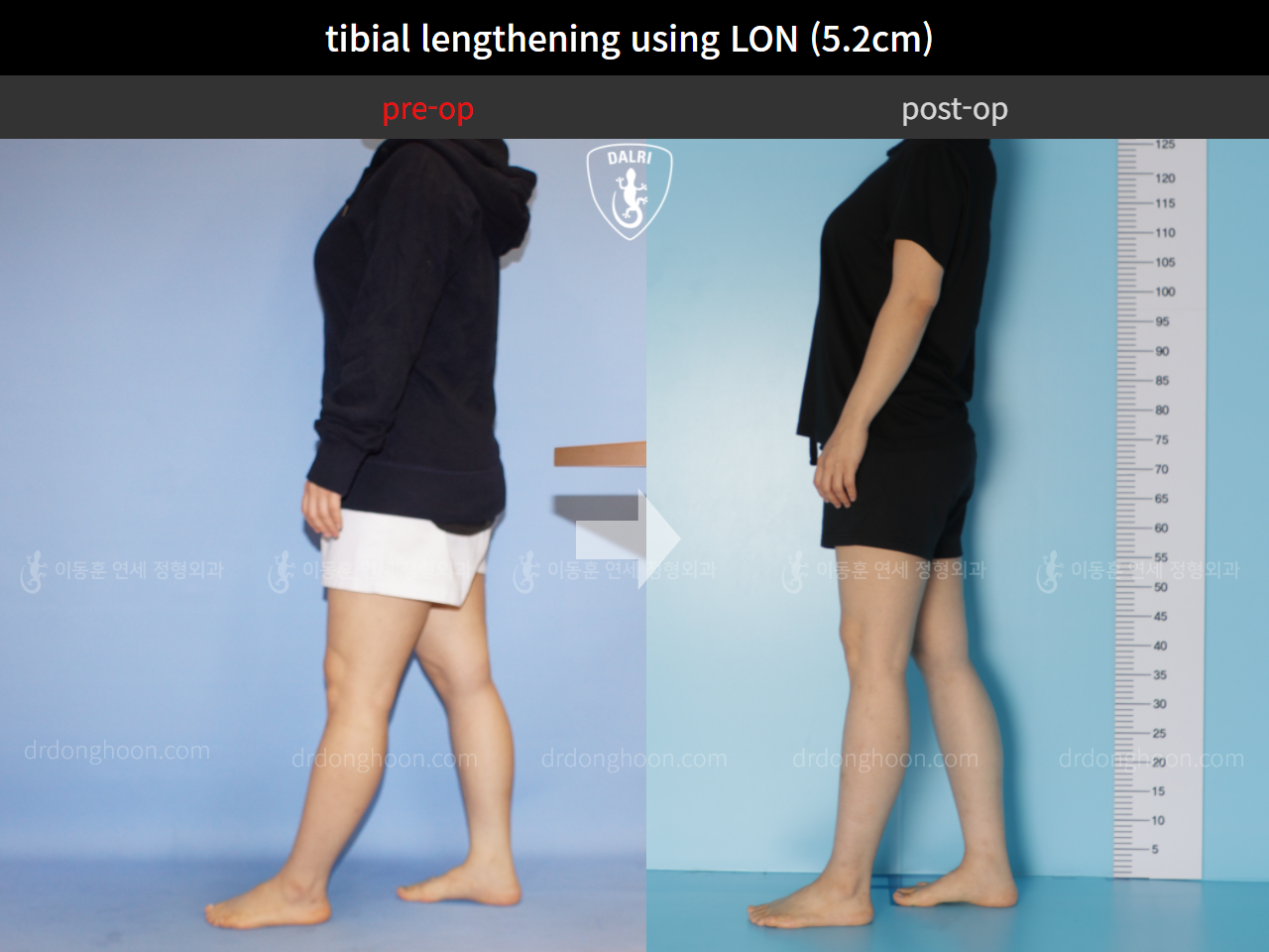 Before and after cll lon, case 4860933, image 4, Dr. Donghoon institute (DALRI)