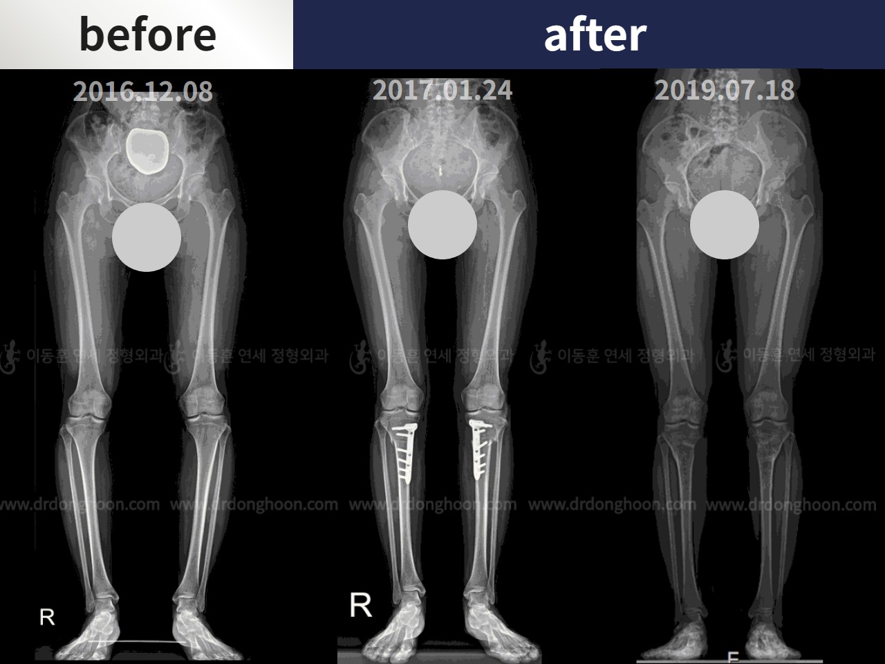Before and after adult bowlegs, case 4311000, image 3, Dr. Donghoon institute (DALRI)