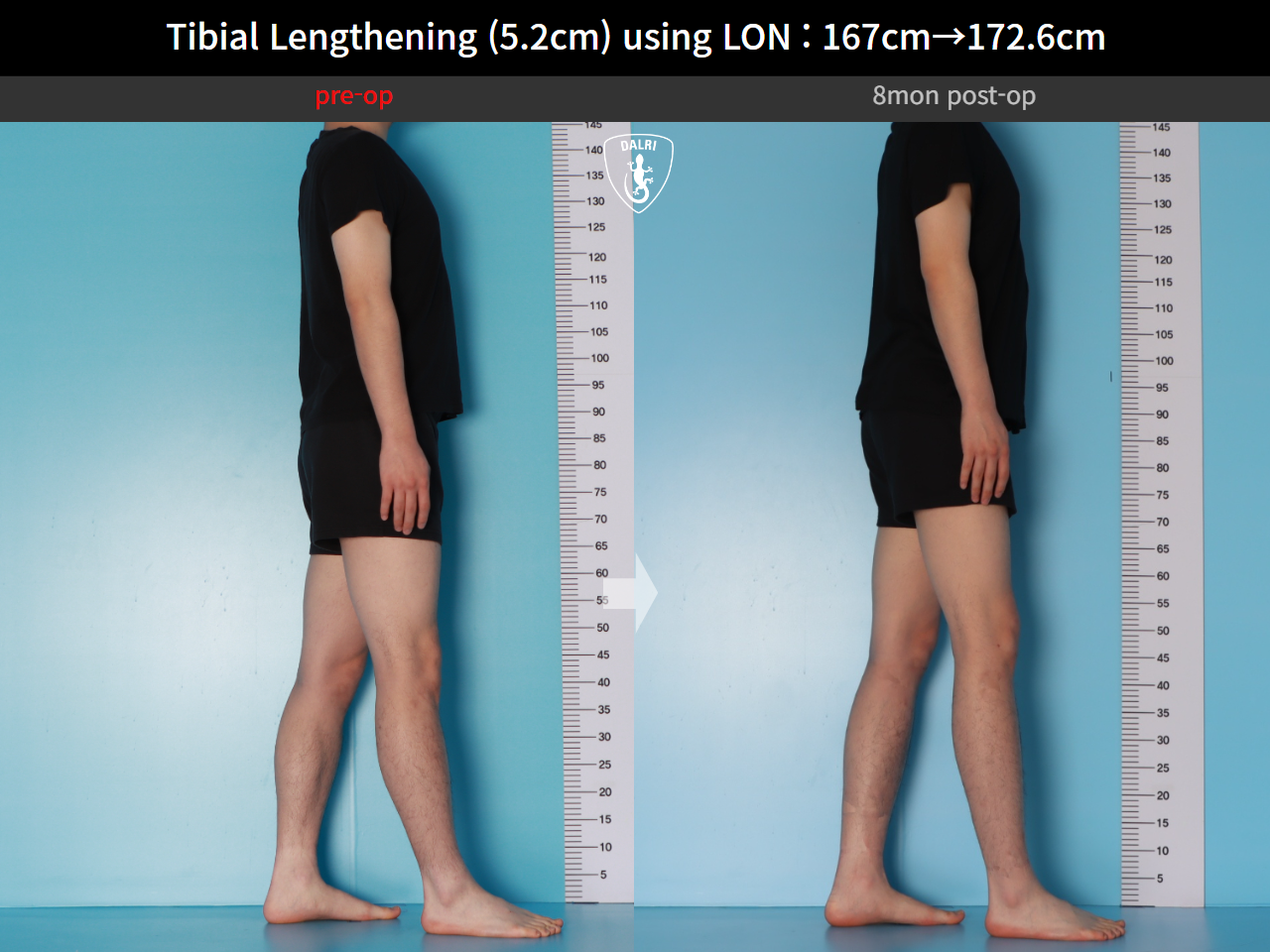 Before and after cll lon, case 29672720, image 5, Dr. Donghoon institute (DALRI)