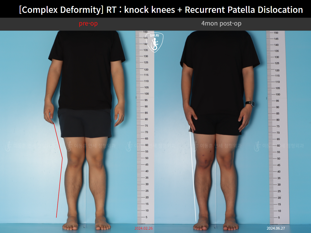 Before and after adult knock knees, case 125841800, image 1, Dr. Donghoon institute (DALRI)