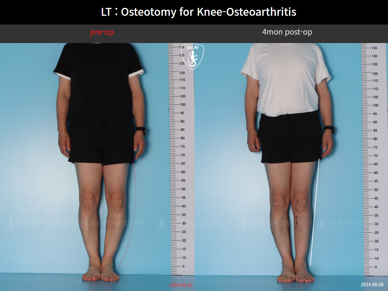 Before and after osteotomy for knee osteoarthritis, case 128374850, image 1, Dr. Donghoon institute (DALRI)
