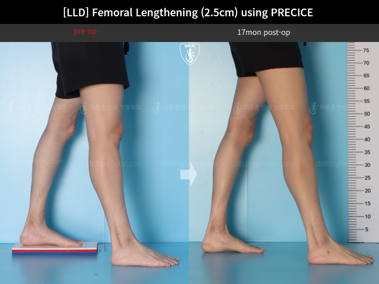 Before and after adult lld, case 18263358, image 8, Dr. Donghoon institute (DALRI)