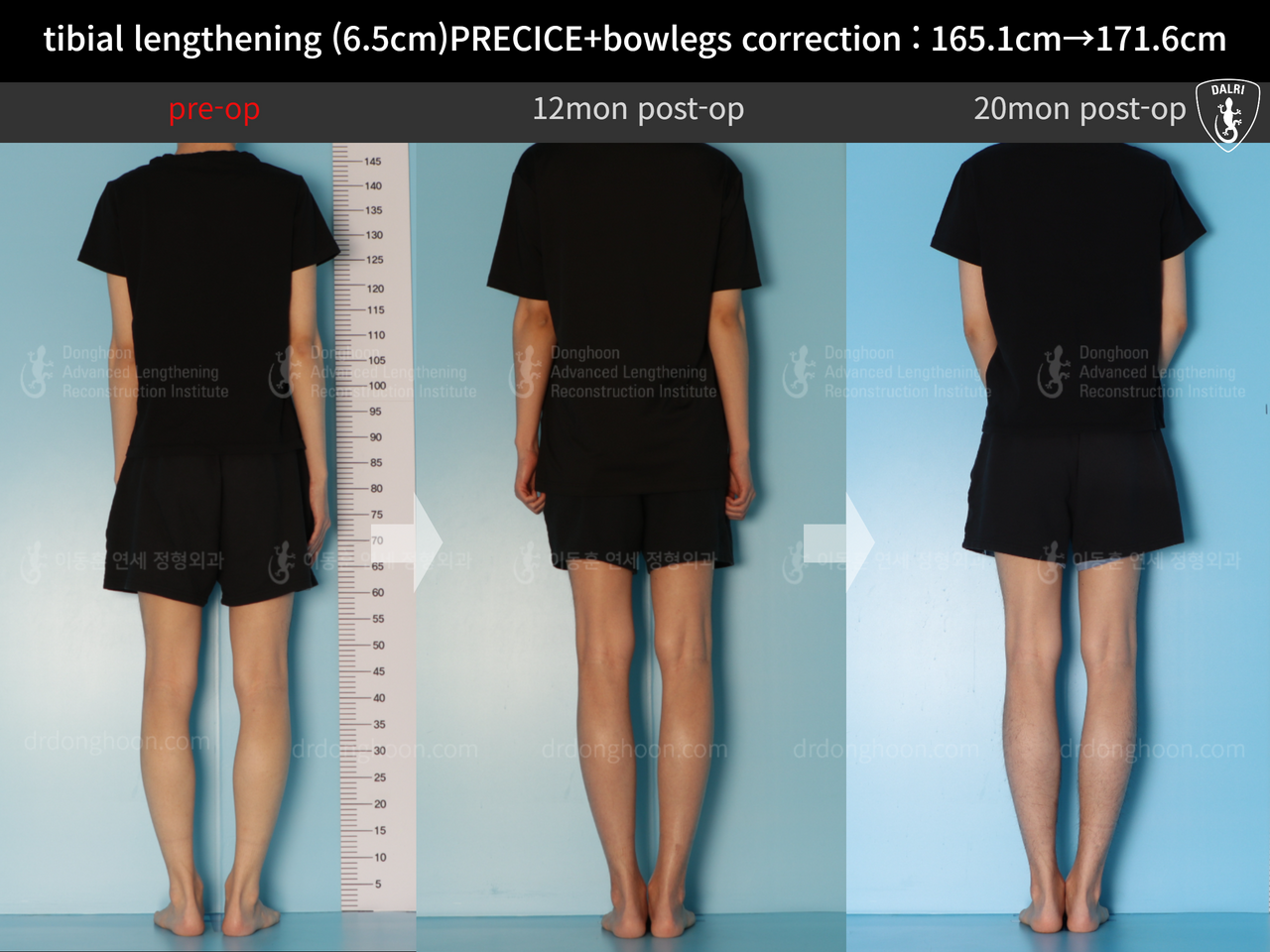 Before and after cll + deformity correction, case 13168253, image 2, Dr. Donghoon institute (DALRI)