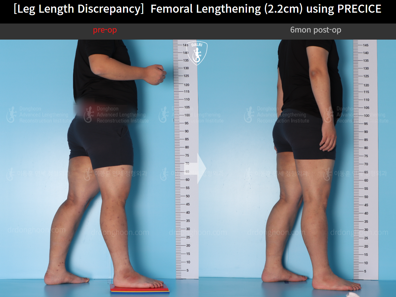 Before and after adult lld, case 15416698, image 2, Dr. Donghoon institute (DALRI)