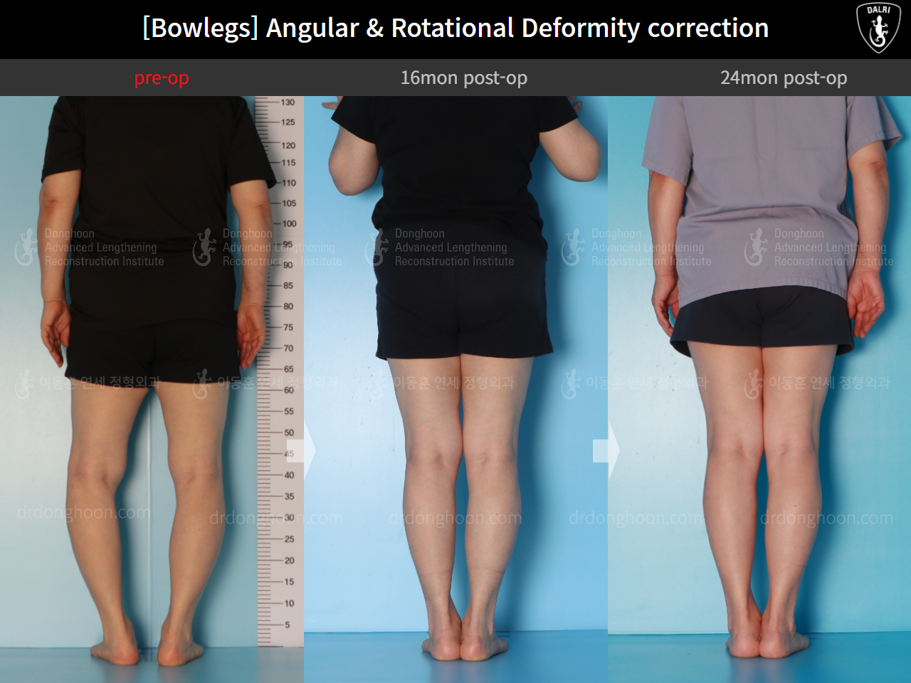 Before and after osteotomy for knee osteoarthritis, case 16074487, image 2, Dr. Donghoon institute (DALRI)