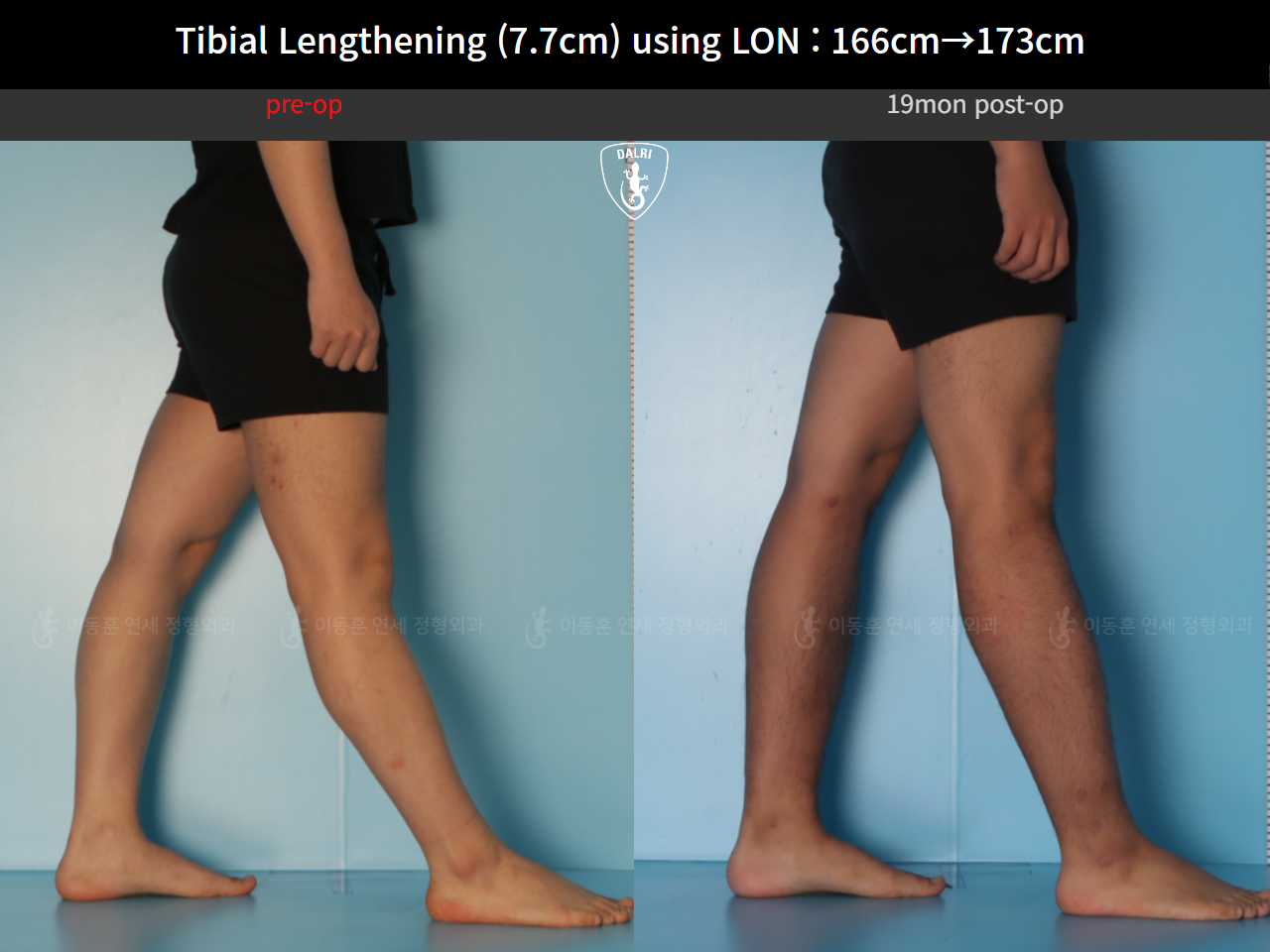 Before and after cll lon, case 126858222, image 8, Dr. Donghoon institute (DALRI)