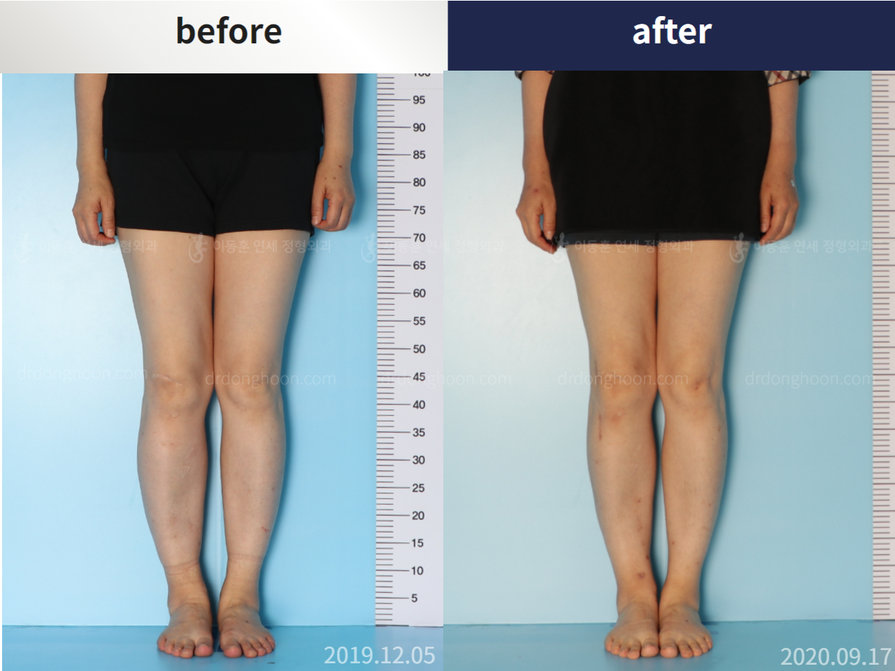 Before and after osteotomy for knee osteoarthritis, case 5203391, image 3, Dr. Donghoon institute (DALRI)