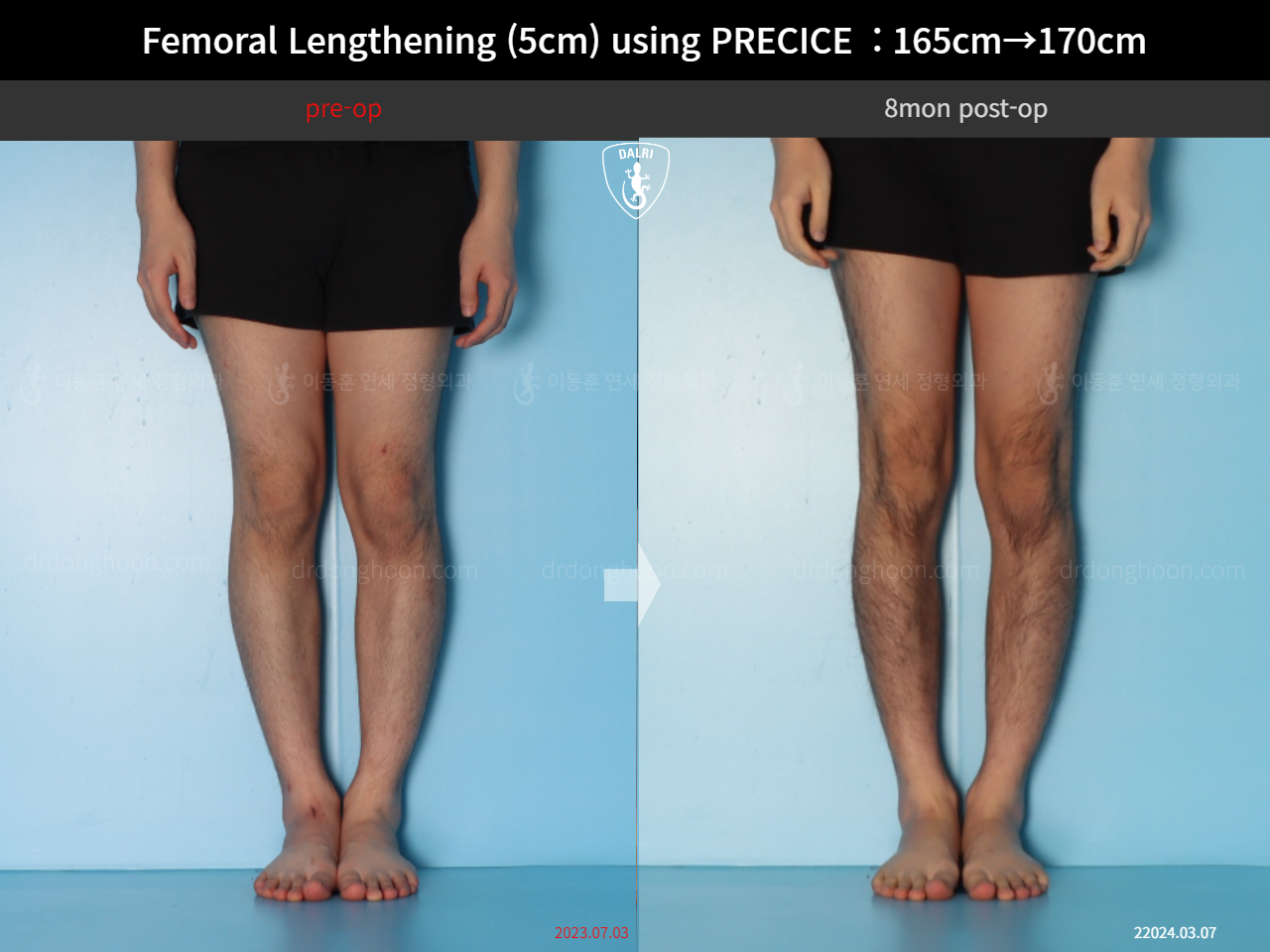 Before and after cll precice, case 18356944, image 7, Dr. Donghoon institute (DALRI)