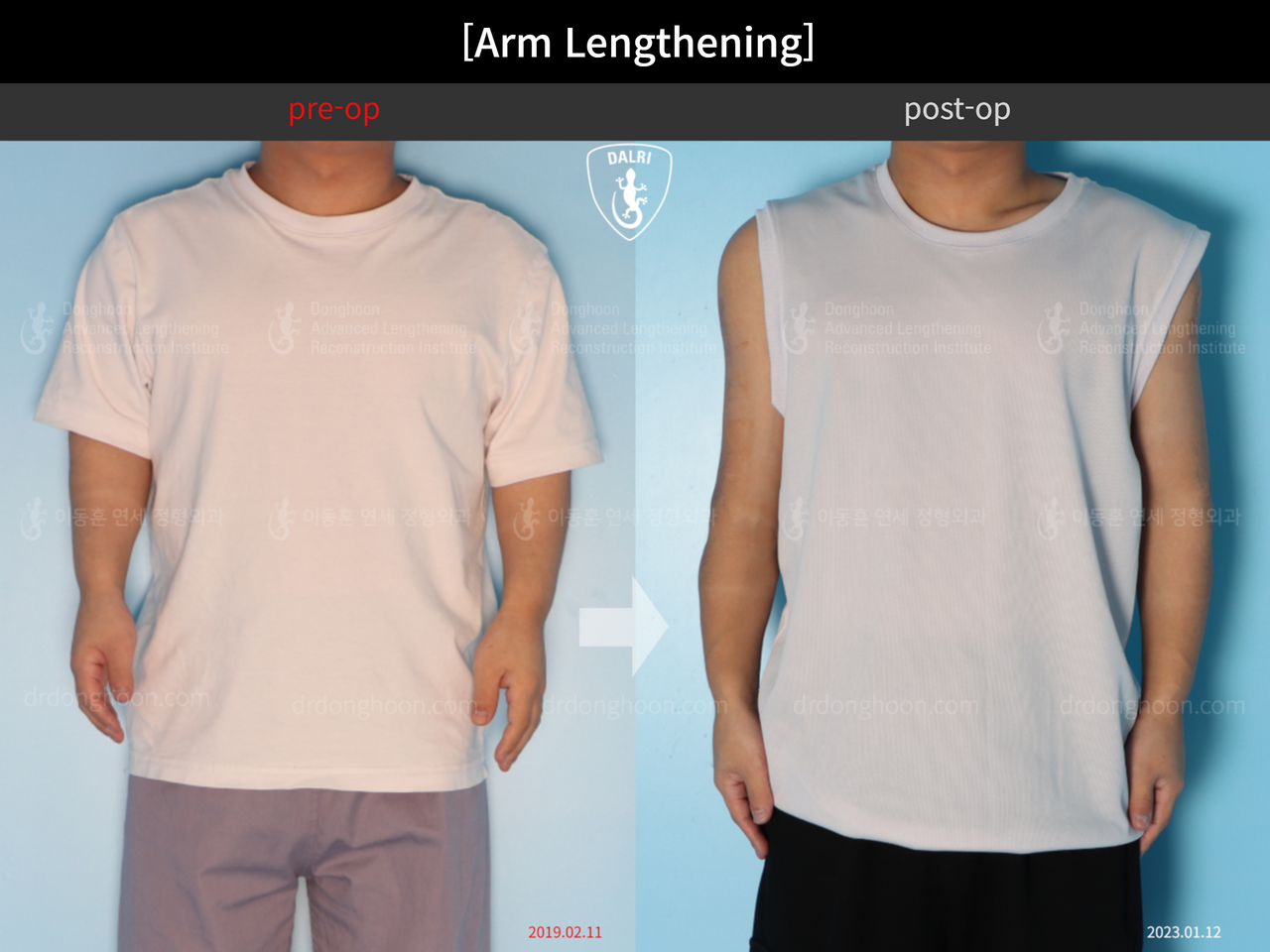 Before and after arm lengthening, case 13957846, image 1, Dr. Donghoon institute (DALRI)