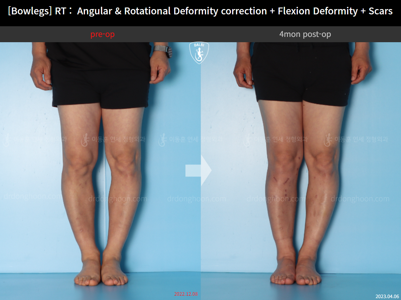 Before and after adult bowlegs, case 14701830, image 5, Dr. Donghoon institute (DALRI)