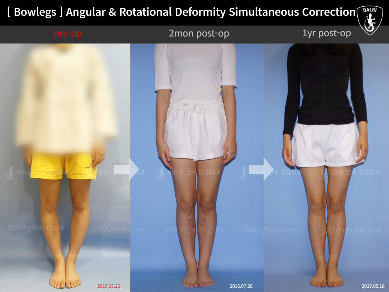 Before and after adult bowlegs, case 9036639, image 1, Dr. Donghoon institute (DALRI)