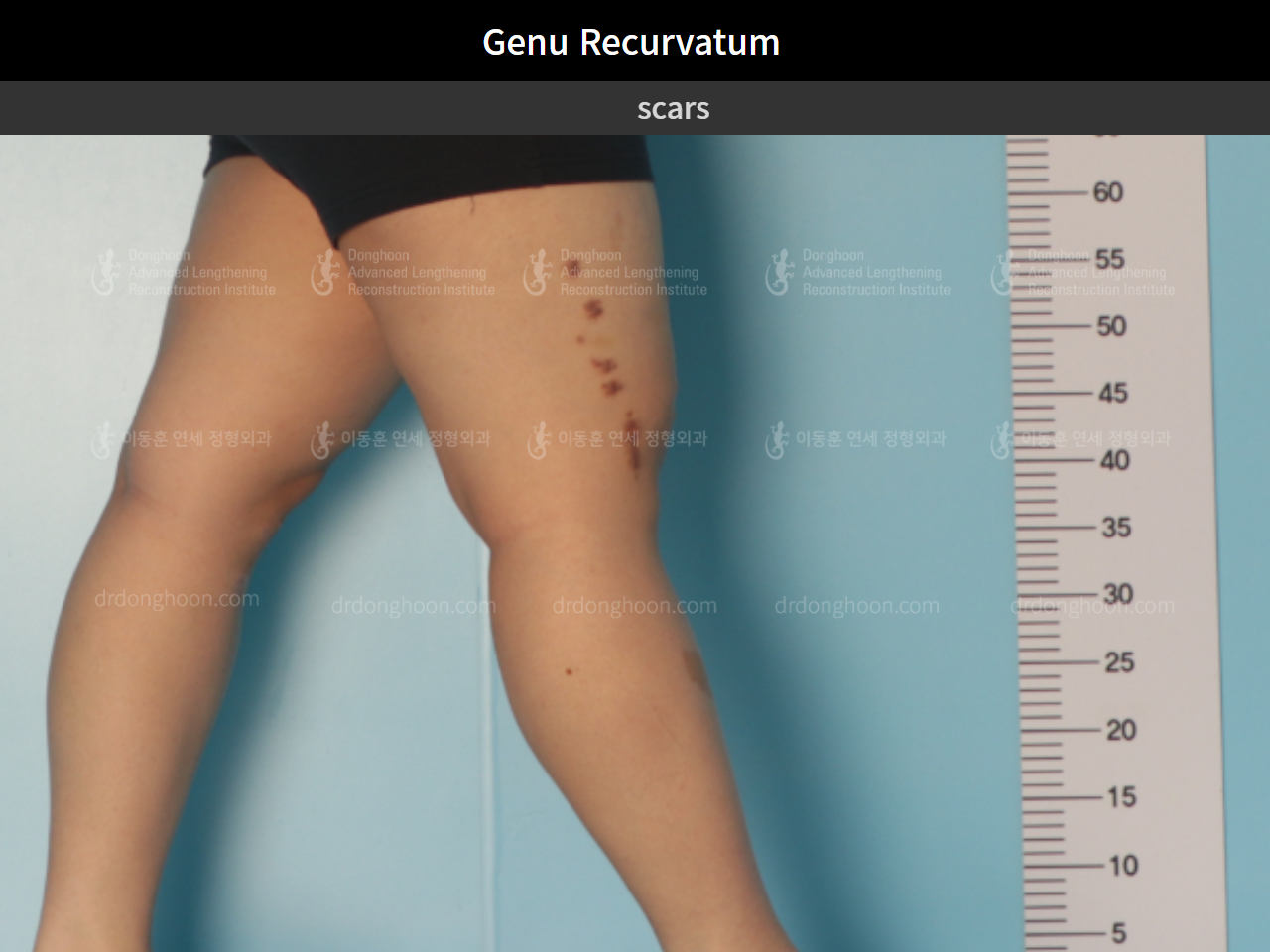 Before and after genu recurvatum, case 5656817, image 3, Dr. Donghoon institute (DALRI)