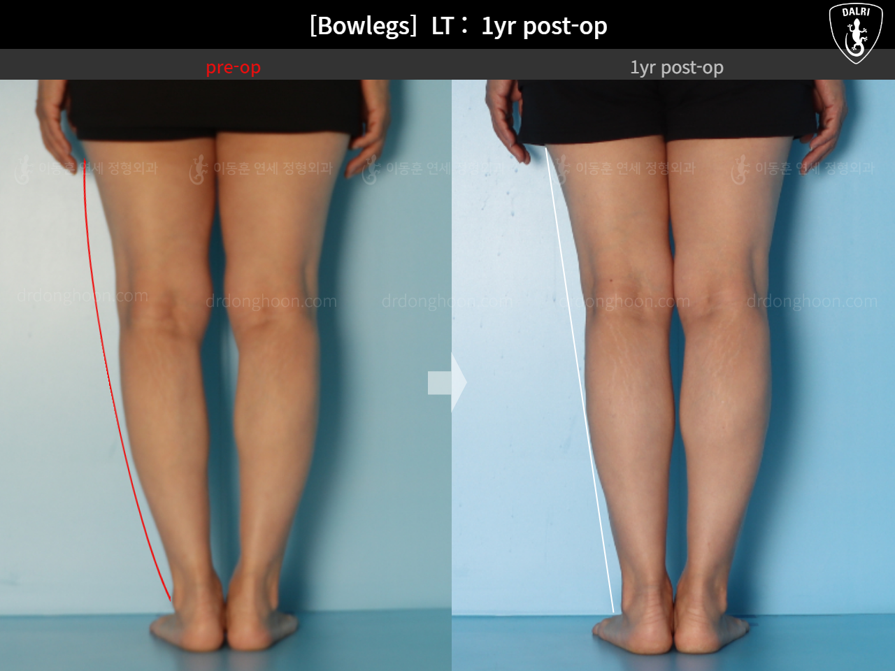 Before and after adult bowlegs, case 15172734, image 9, Dr. Donghoon institute (DALRI)