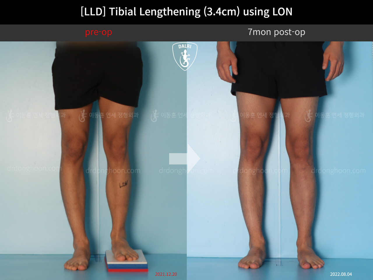 Before and after adult lld, case 12529689, image 4, Dr. Donghoon institute (DALRI)