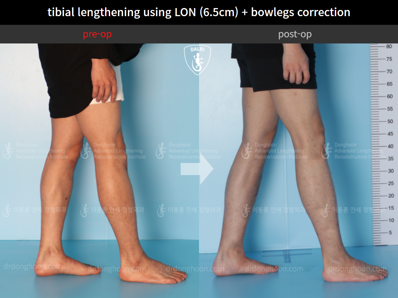 Before and after cll + deformity correction, case 4585639, image 8, Dr. Donghoon institute (DALRI)