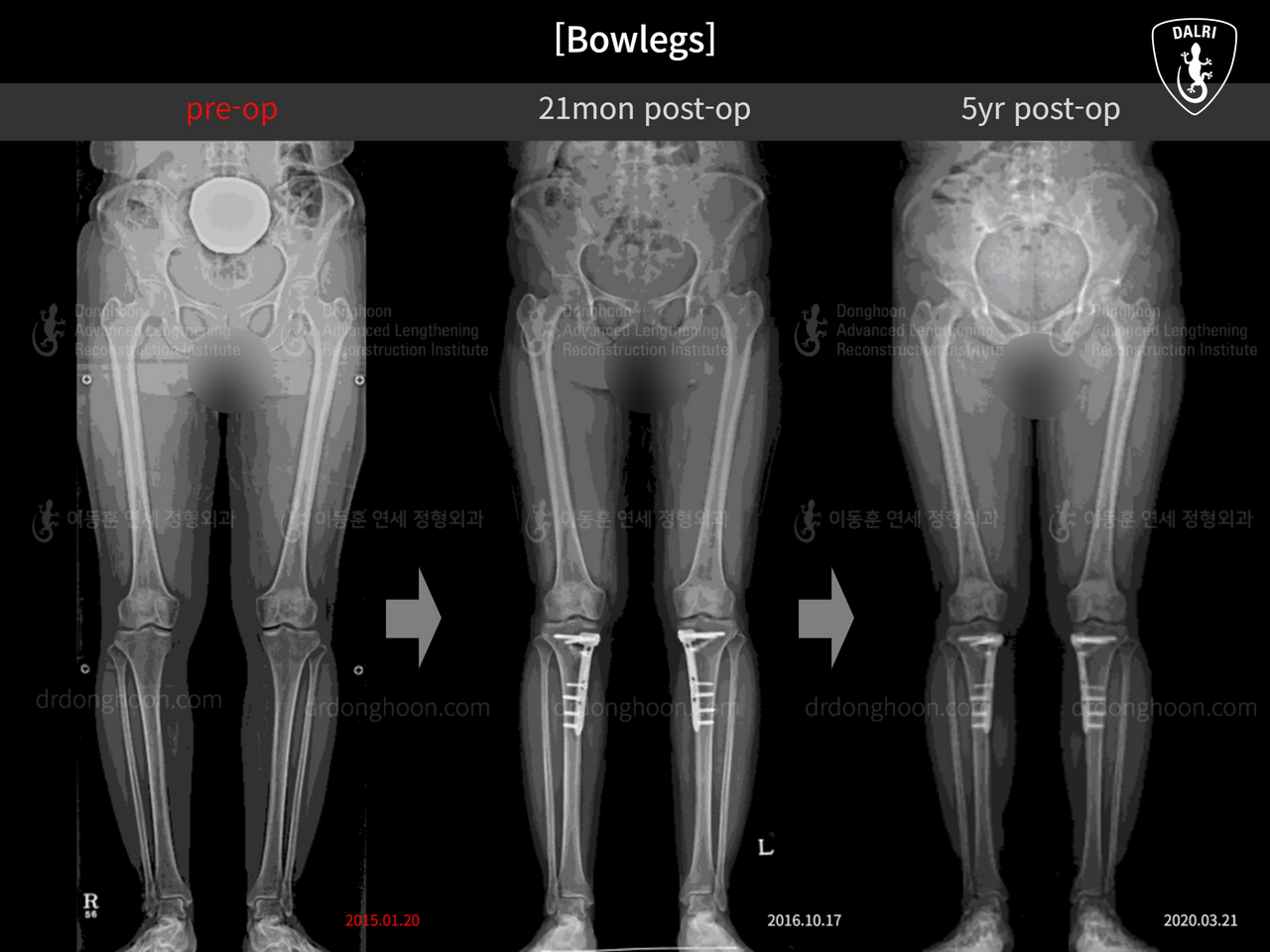 Before and after adult bowlegs, case 13567064, image 6, Dr. Donghoon institute (DALRI)