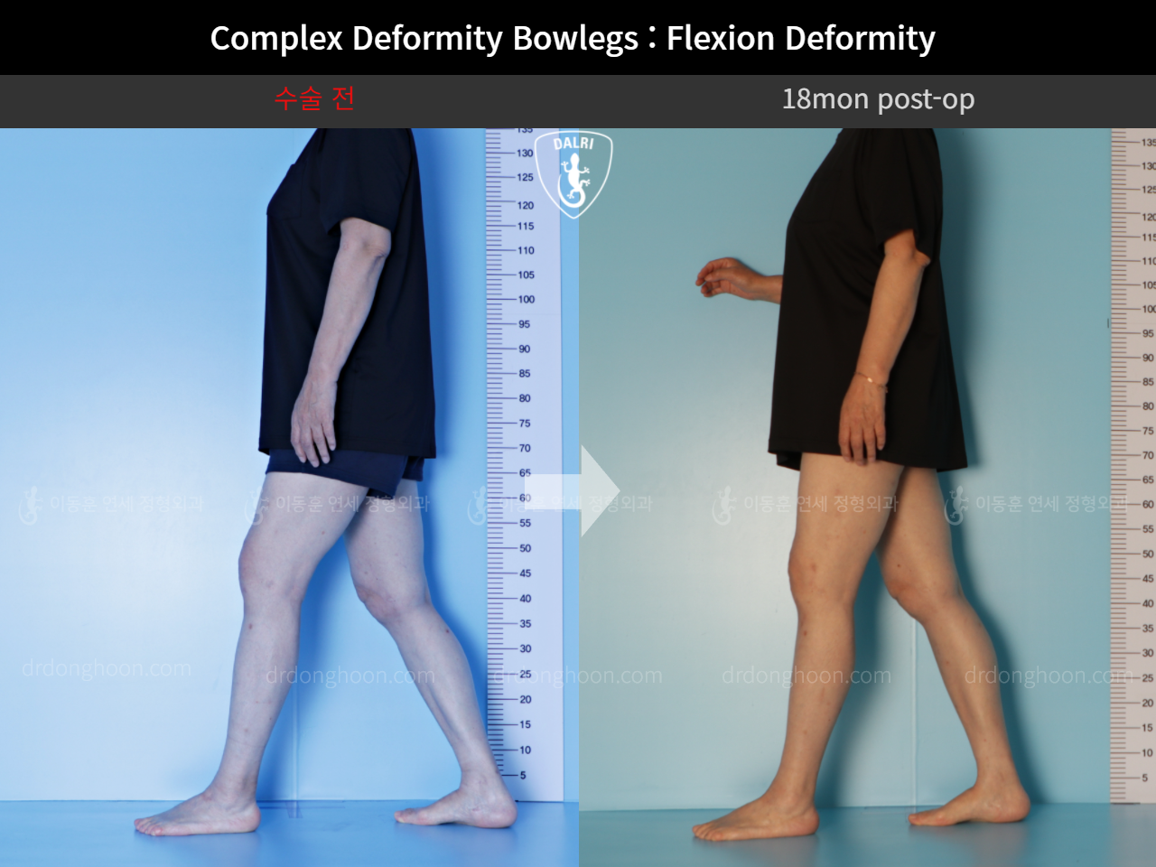 Before and after adult bowlegs, case 11337461, image 5, Dr. Donghoon institute (DALRI)