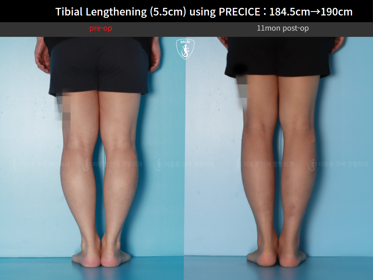 Before and after cll precice, case 125279355, image 8, Dr. Donghoon institute (DALRI)