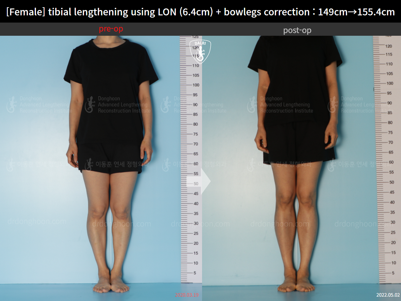 Before and after cll + deformity correction, case 15615036, image 1, Dr. Donghoon institute (DALRI)