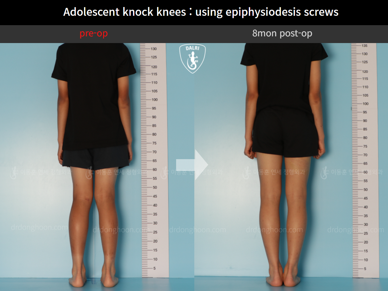 Before and after paediatric & adolescent knock knees, case 10171145, image 2, Dr. Donghoon institute (DALRI)